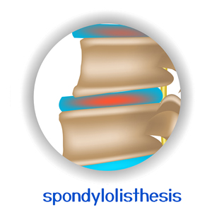 picture of Manchester spondylolisthesis